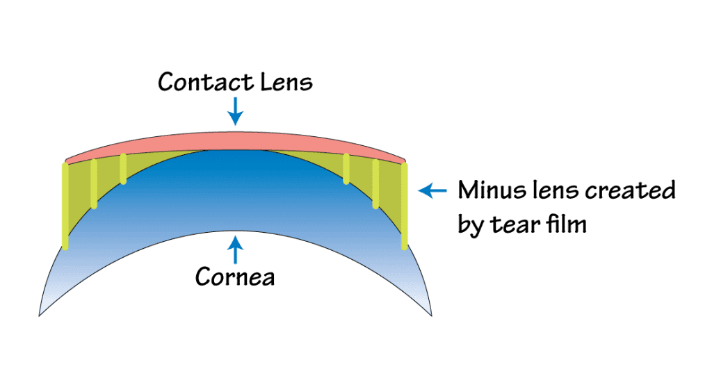 Vertex distance ของคอนแทคเลนส์