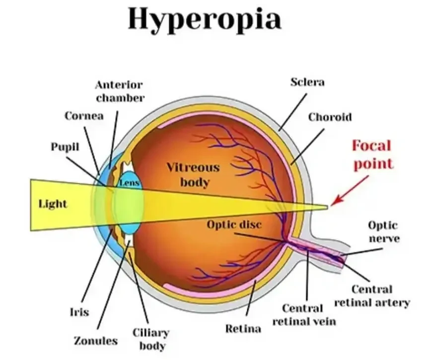 ลักษณะค่าสายตายาว